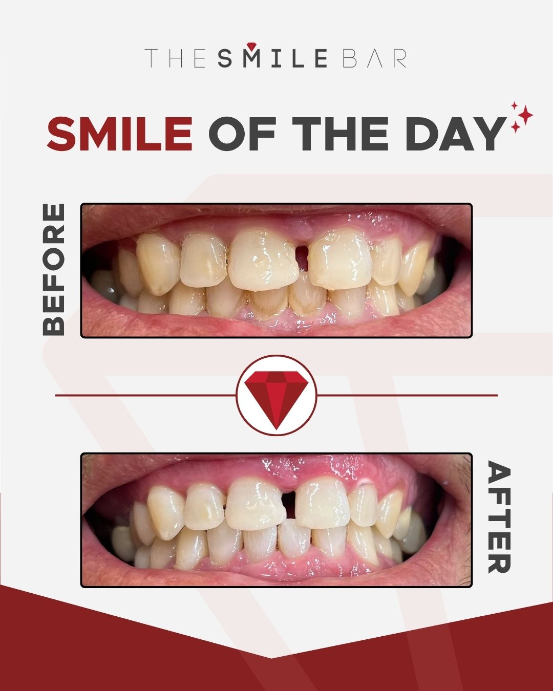 Smile of the day before and after result 1