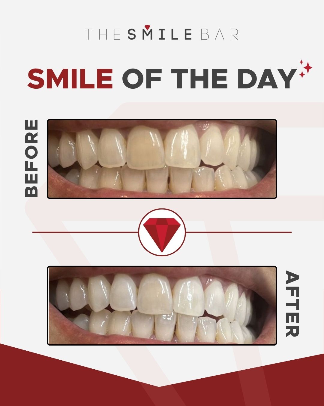 Smile of the day before and after result 2