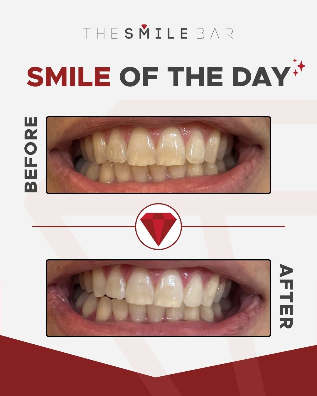 Smile of the day before and after result 3